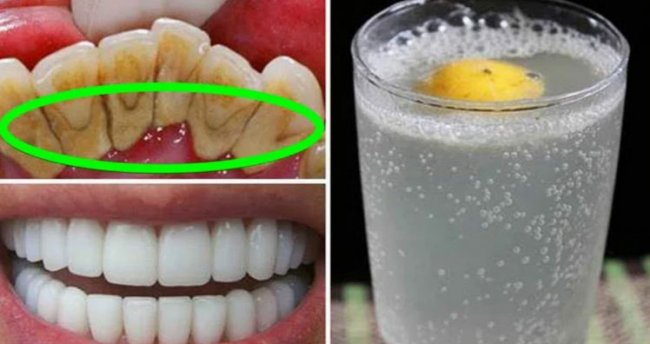 Как быстро отбелить зубы в домашних условиях