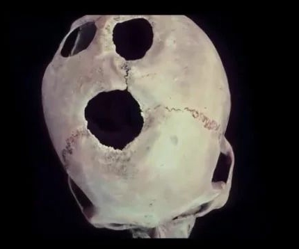 В подводных пещерах дайверы нашли удивительный череп с вживленным микроимплантом